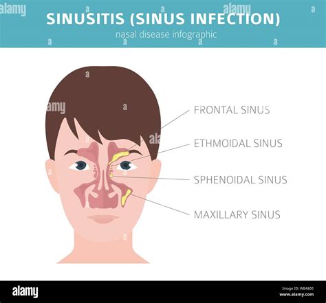 Nasal Diseases Sinusitis Sinus Infection Diagnosis And Treatment