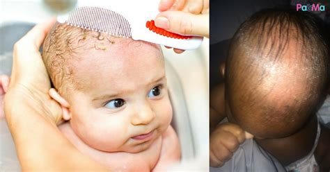 Pada asalnya menggundul kepala bayi adalah suatu yang dianjurkan. Kerak Di Kepala Bayi Punca Ketidakselesaan, 5 Tip Cuci ...