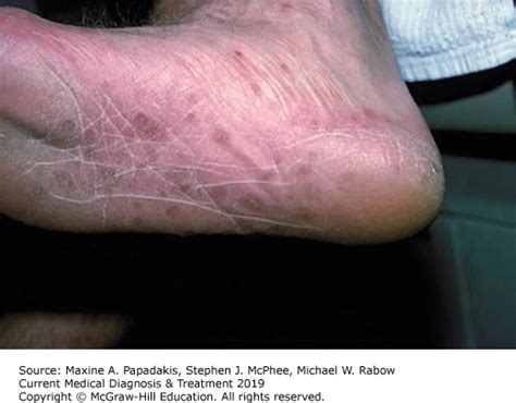 Lamotrigine Rash On Feet