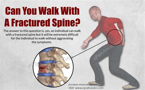 Lumbar Spine Fracture Treatment