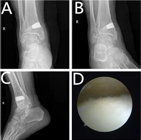 3d Printing Assisted Supramalleolar Osteotomy For Ankle Osteoarthritis