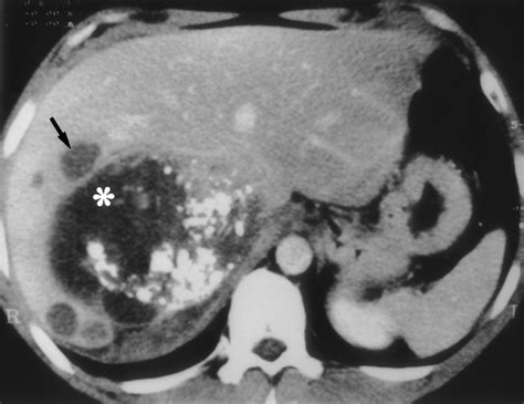 Imaging Features Of Uncommon Adrenal Masses With Histopathologic