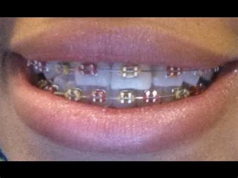 How to make braces rubber bands stop hurting. Come along with me to the Orthodontists‎ another rubber ...