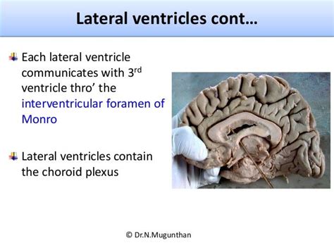 Lateral Ventricle Of Brain By Drnmugunthanms Plexus Products