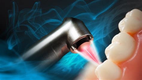Minimally Invasive Laser Dental Procedure Dr Suffolettas Dentistry
