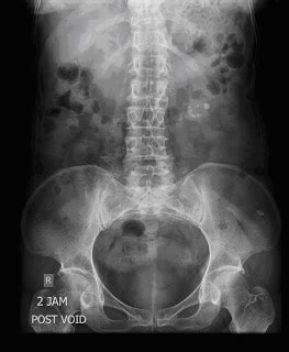 Beda dg rontgen thorax biasa yah gaes. Dasar-Dasar Radiologi : Foto BNO-IVP - Catatan Dokter