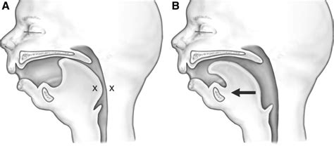 The Tongue Lip Adhesion Operative Techniques In Otolaryngology Head