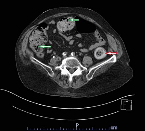 CT Of The Abdomen And Pelvis Without Contrast Showing A Moderate Amount