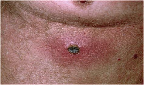 The Rash That Leads To Eschar Formation Clinics In Dermatology