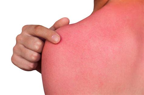 Sunburn Definition And Meaning Collins English Dictionary