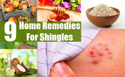 9 Home Remedies For Shingles Vistasol Medical Group