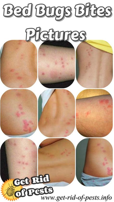 How itchy are bed bug bites? Do Bed Bug Bites Itch All The Time ~ Bed Bug Get Rid