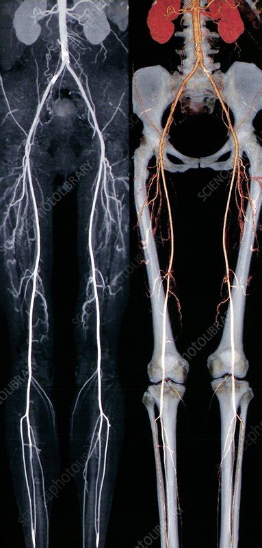 Normal Leg Arteries Angiograms Stock Image C0017924 Science