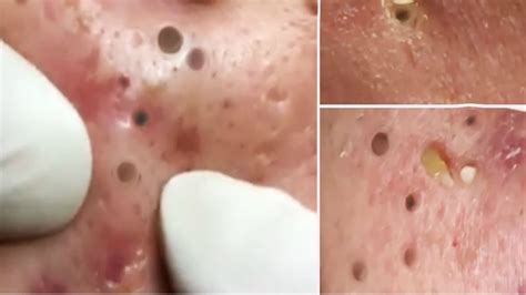 Satisfying Doctor Pimple Blackhead Removal 2020 Youtube
