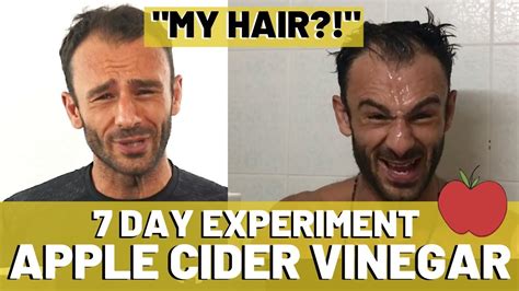 Apple Cider Vinegar Results For Hair Loss 7 Days Youtube