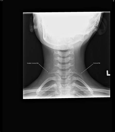Cervical Ribs And Thoracic Outlet Syndrome Radiologypicscom
