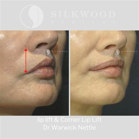 Lip Lift Surgery Exposes More Of Your Top Lip Making It Appear Fuller Corner Lip Lift Surgery