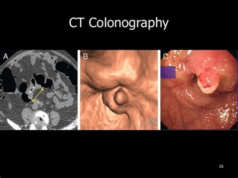 Ct colonography is an example of this process. Can a CT scan detect any abnormal lump in colon? - Quora