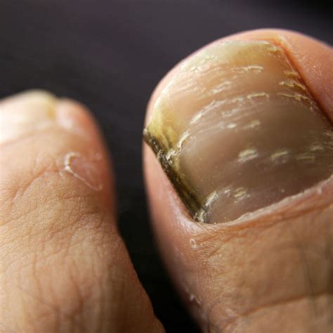 What Is Black Toenail Fungus Forces Of Nature Medicine
