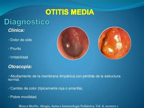 Patología Infecciosa Del Oído Otitis Media