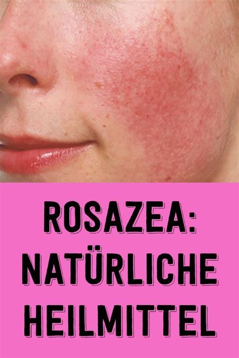 Rosacea Natural Remedies Rosazea Gesicht Pflege Rosacea Behandlung