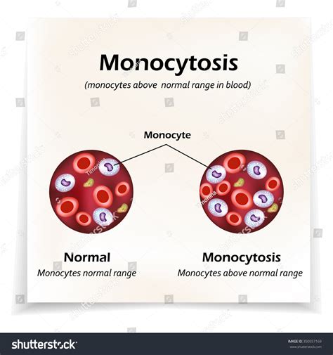 Monocytes Above Normal Range Blood Monocytosis เวกเตอร์สต็อก ปลอดค่า