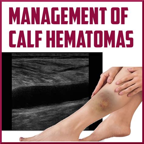 Management Of Calf Hematomas Sports Medicine Review