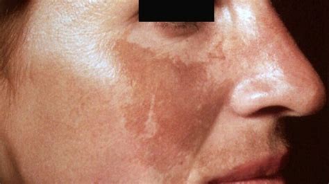 How Does Melasma Arise And What Is The Best Way To Treat It — Fem Surgery