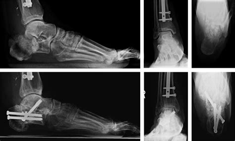 Management Of The Subtalar Joint Following Calcaneal Fracture Malunion