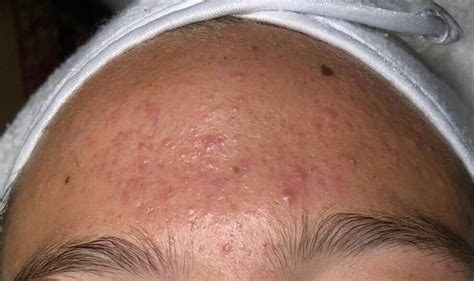 The Main Causes Of Forehead Acne And How To Fix It — Aes Beauty