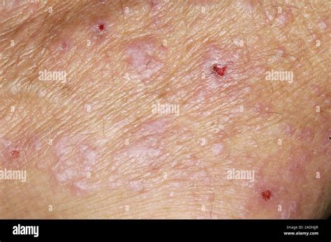 Model Released Lichen Planus Disease Close Up Of The Skin Of A 55