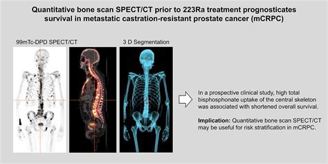 The Prognostic Value Of Quantitative Bone SPECT CT Before Ra Treatment In Metastatic