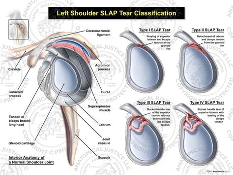 Left Slap Tear Classification