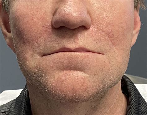 Plastic Surgery Case Study Large Vertical Chin Lengthening Osteotomy