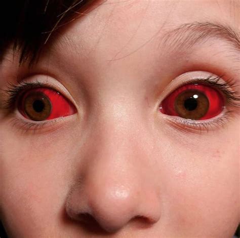 Patient With A Spontaneous Subconjunctival Hemorrhage Medizzy