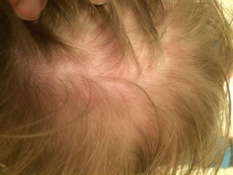 Little Red Bumps On Scalp