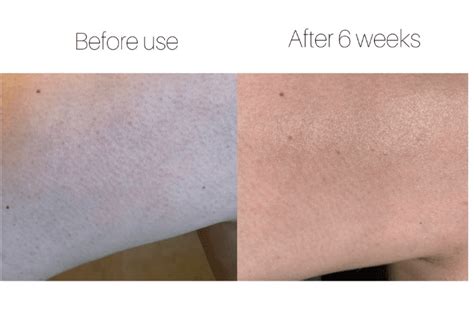 Treating The Bumps On The Back Of My Arms Testimonial Ameliorate