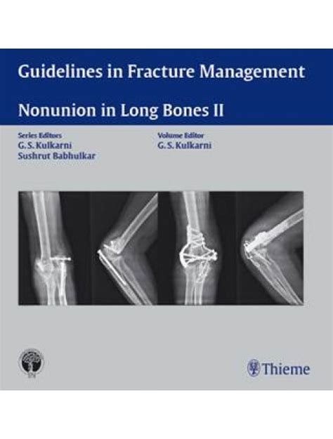 Guidelines In Fracture Management Nonunion In Long Bones Ii