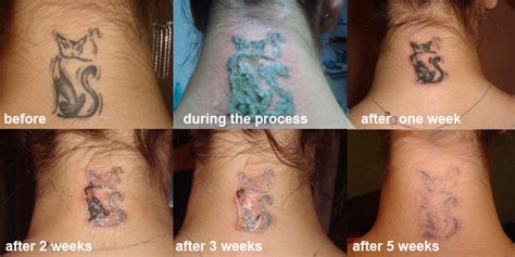 Rejuvi Tattoo Removal How It Works And Which Clinic