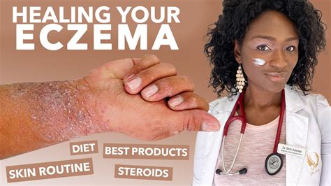 How To Treat Eczema Atopic Dermatitis Black Dark Skin Dry Flaky