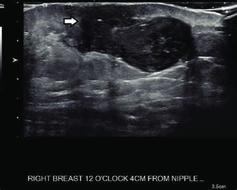 A 76 Year Old Male Who Presented With An Enlarging Right Breast Lump