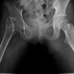 Pdf Paediatric Bilateral Femoral Neck Fractures In Osteopetrosis The Best Porn Website