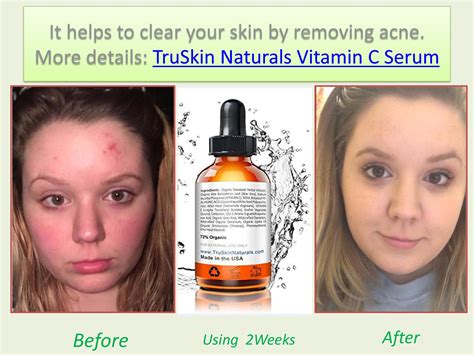 Amazon customers are obsessed with truskin naturals $20 vitamin c serum. Truskin naturals vitamin c serum review 2018 | Vitamin c ...