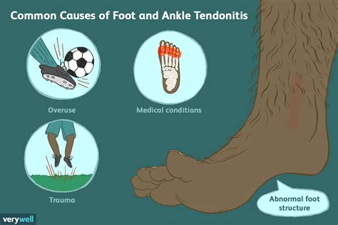 Exercises For Extensor Tendonitis In Foot Exercisewalls
