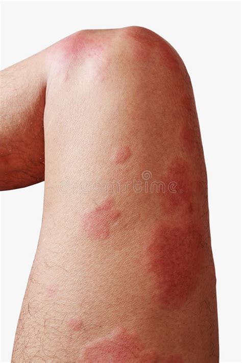 Around Legs Allergy Rash And Health Problem Stock Photo Image Of