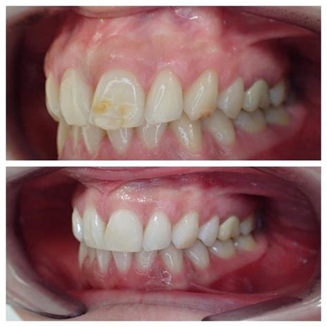White Fillings Cosmetic The Whyte House Dental Practice Exeter