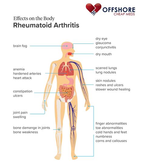 Rheumatoid Arthritis Symptoms Causes Treatment And More 1