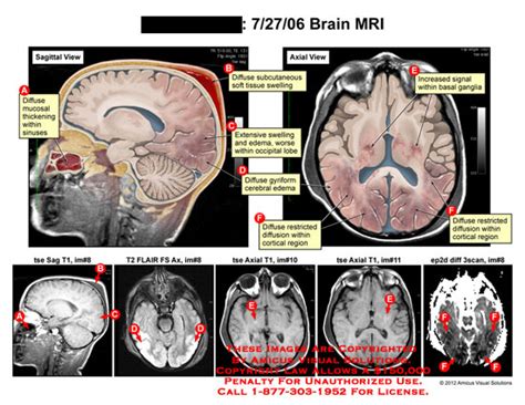 AMICUS Illustration Of Amicus Injury Brain MRI Head Mucosal Sinuses