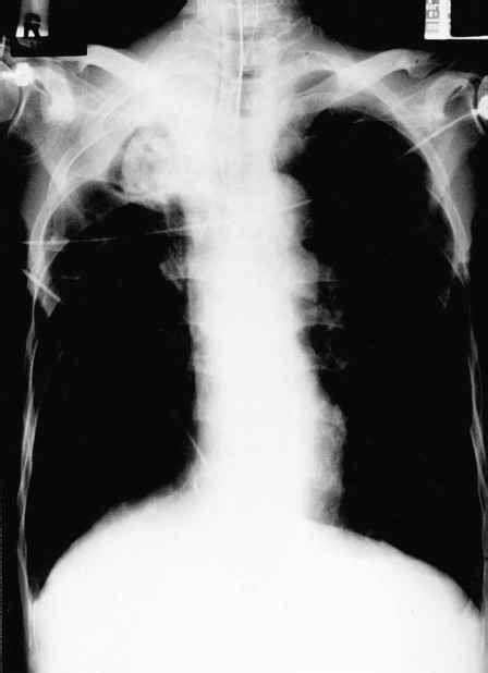 If none is present the fluid is virtually always a transudate. Case 15 Pseudotumor Due To Loculated Right Pleural ...