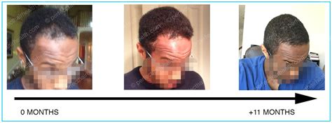 Here's what you need to know. How Vitamin D Deficiencies Can Cause Hair Loss (See Photos)
